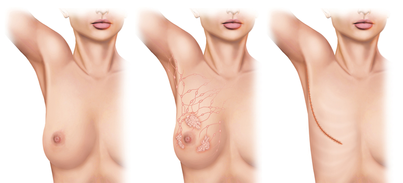 Mastectomy Options in Breast Cancer Treatment - By Fiona Stevenson